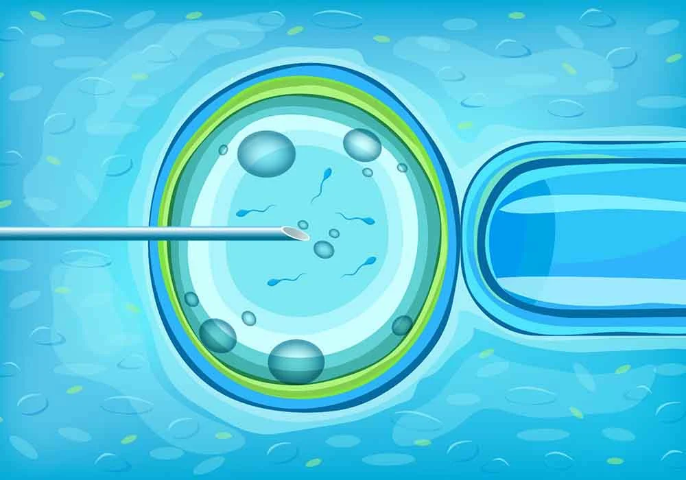 IVF